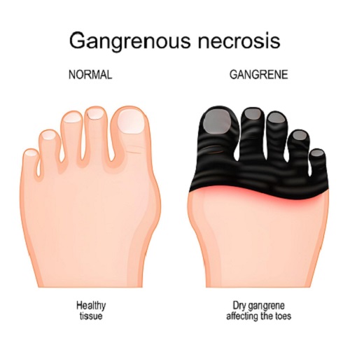 Best Doctor for Gangrene in Vile Parle, Mumbai